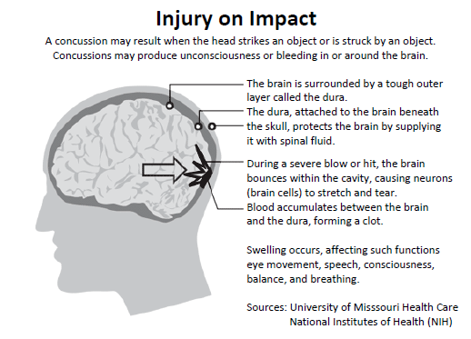 Concussion - Memory Loss Cause - MemoryHealthCheck